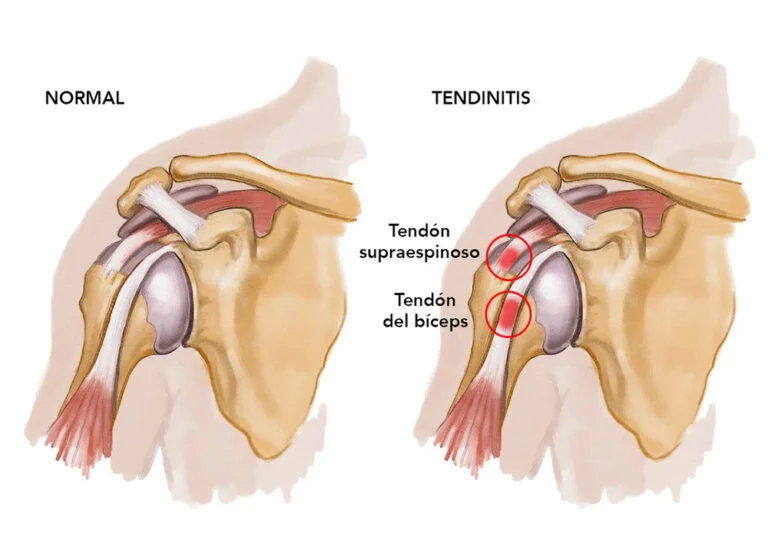 PORTADA TENDINITIS - ¿Qué es la tendinitis de hombro? | Clínica DKF