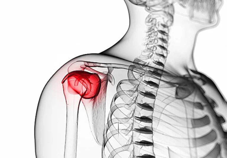 Sin titulo 1 Recuperado Recuperado Recuperado Recuperado Recuperado Recuperado Recuperado - Qué es la bursitis de hombro: síntomas, diagnóstico y tratamiento | Clínica DKF